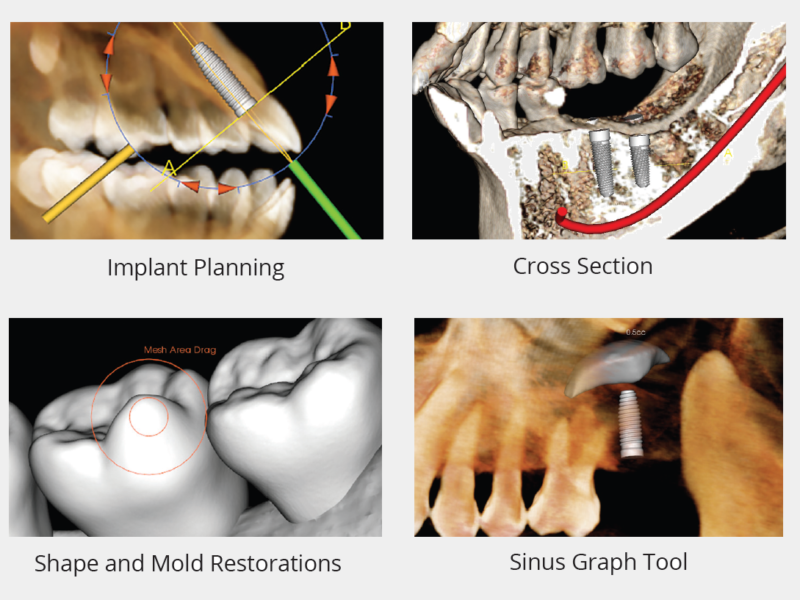 Invivo - Implant planning features SELECTED on grey Invivo - Implant planning features SELECTED on grey